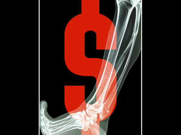 Uncovering Egregious Overbilling in Orthopedic Surgery